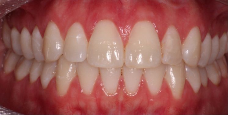 Close up of a smile with slightly yellowed teeth